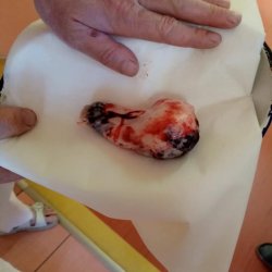 Nádor v porovnání s mužskou rukou 