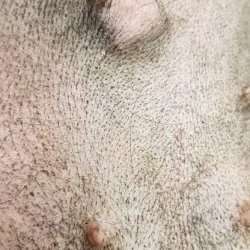 Nádor na mléčné žláze