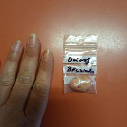 Březinčin močový kámen